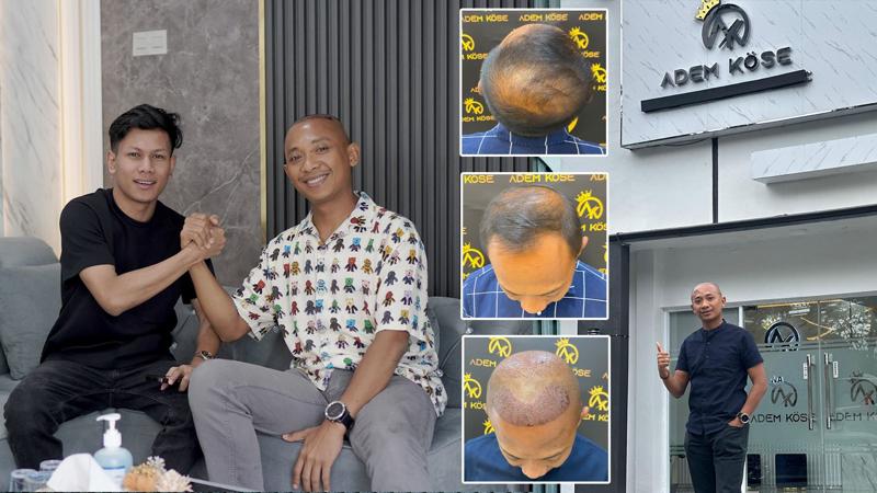Ademkose Hair Transplant Hadir di Indonesia, Siap Jadikan Yogyakarta Pusat Medical Tourism Dunia